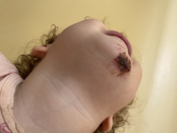 Годовалый ребенок получил травму подбородка на опасной площадке в ЖК «Зенит»