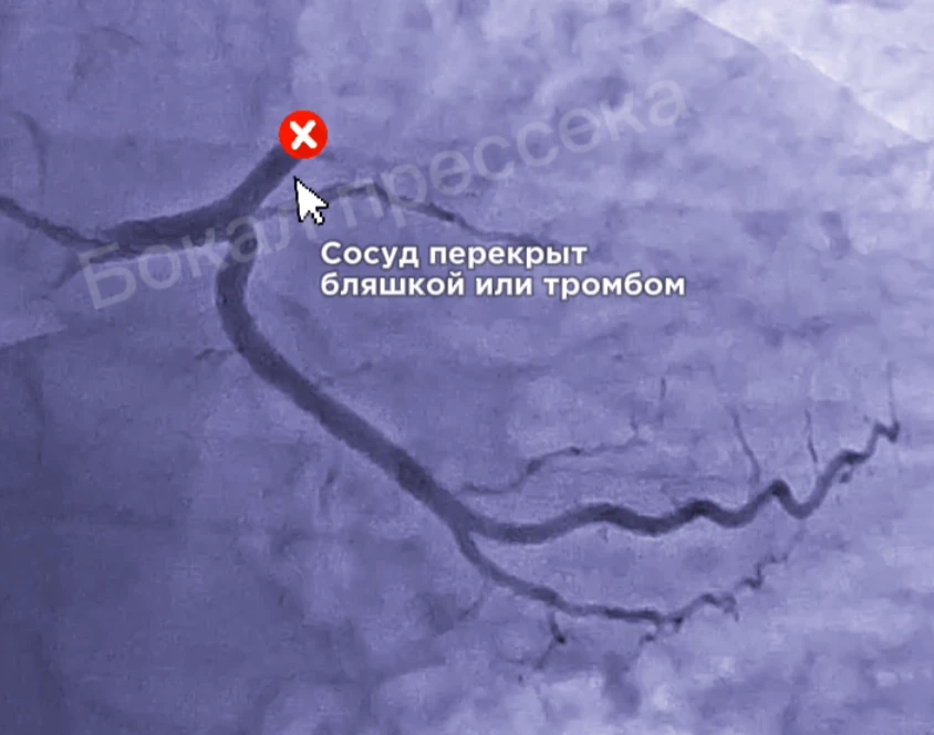 Врачи ЦГБ Арзамаса спасли молодого мужчину, которому грозила смертельная опасность